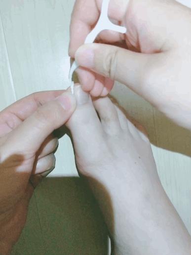 甲沟炎好痛怎么办,甲沟炎又疼又难受教你一招解决