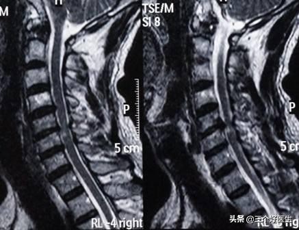 脊椎退化性改变,脊椎退化怎么治疗效果最好