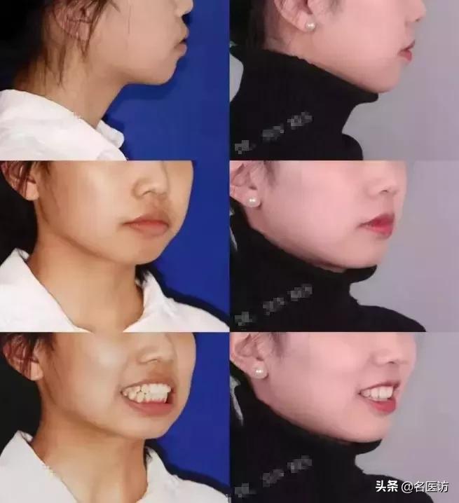 戴牙套2年不戴保持器反弹案例,戴牙套成功案例不戴保持器