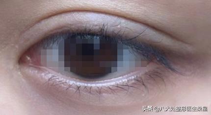 双眼皮手术开眼角恢复过程,双眼皮全切开眼角恢复期图