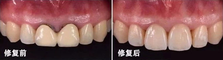 口腔假牙以旧换新活动,镶牙活动假牙