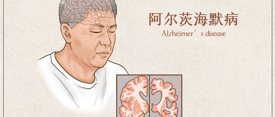 老年痴呆移植干细胞视频,老年痴呆回输干细胞有用吗