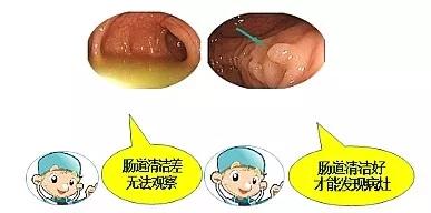 不这样准备肠道,这次肠镜就白受罪了