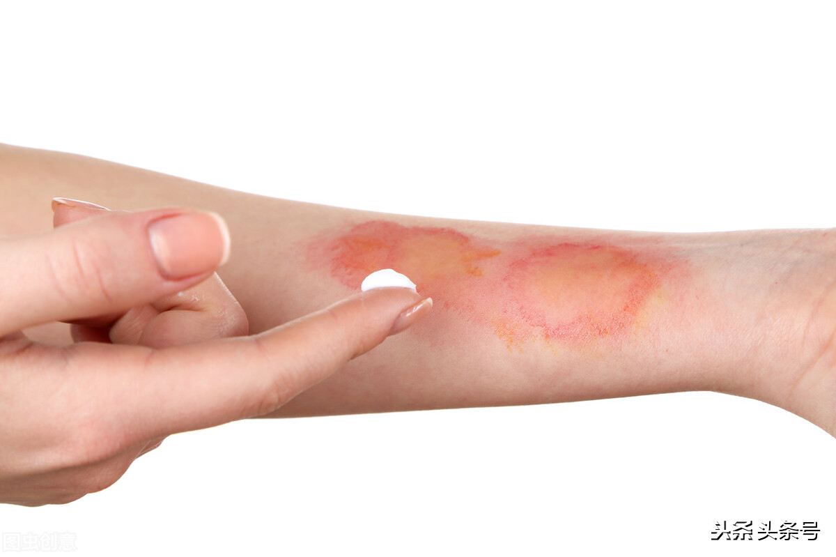 烫伤好了有红色凸起是疤痕增生吗,祛烫伤疤痕增生最简单的方法