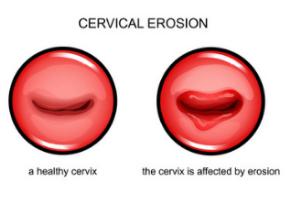 宫颈二度糜烂且检查时出血是癌吗,宫颈糜烂要做什么检查可以查出来