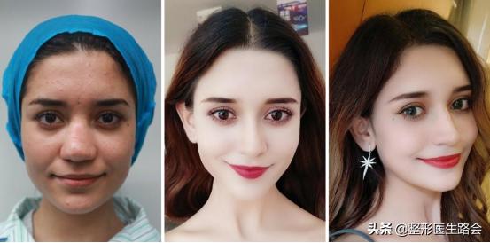 鼻翼缩小外切好吗,鼻翼缩小外切还是内切效果好