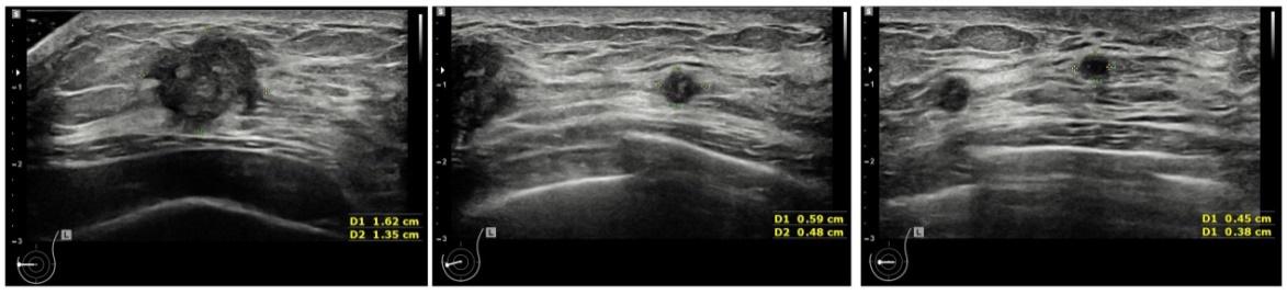 乳腺癌转移到肝医生说动不了手术,乳腺癌肺转移不放化疗可以治吗