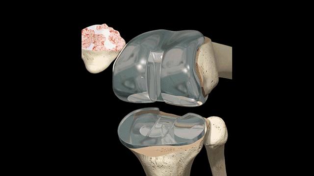 膝盖走路咯噔响还疼是什么原因,膝盖弯曲膝盖响是什么原因