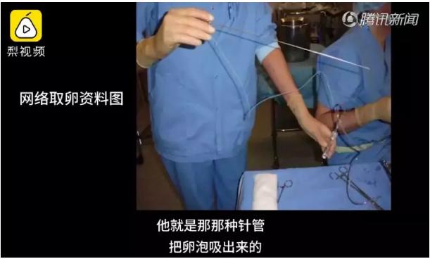 女大学生捐卵费用多少,女大学生捐29个卵