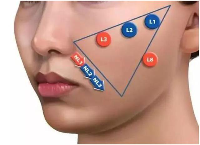 线雕和玻尿酸筋膜提升有什么区别,玻尿酸线雕是什么样子