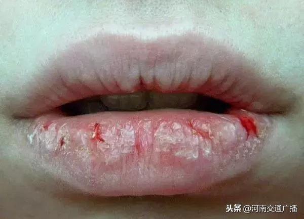 孕妇嘴唇干裂脱皮痛怎么办,孕妇嘴唇干裂脱皮没有口红怎么办
