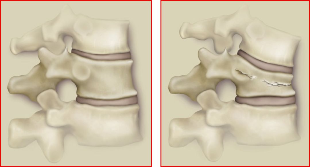 腰椎压缩骨折椎体成形术啥时候做,骨质疏松骨折椎体成形术操作步骤