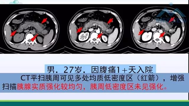急性胰腺炎的护理措施,急性胰腺炎影像与临床