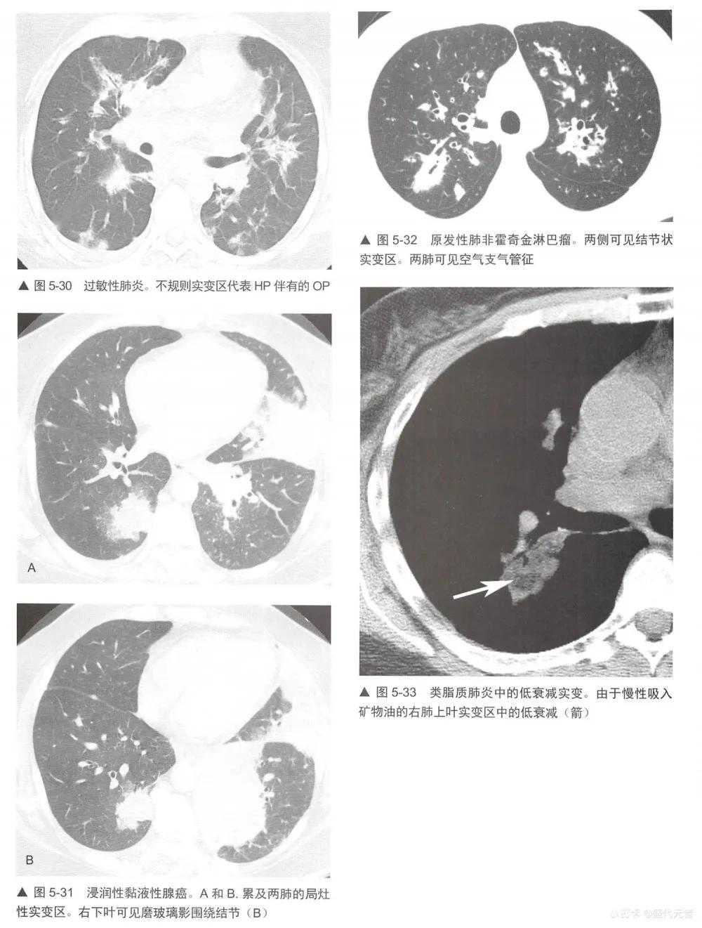 肺hrct诊断思路,肺部hrct检查呈阳性