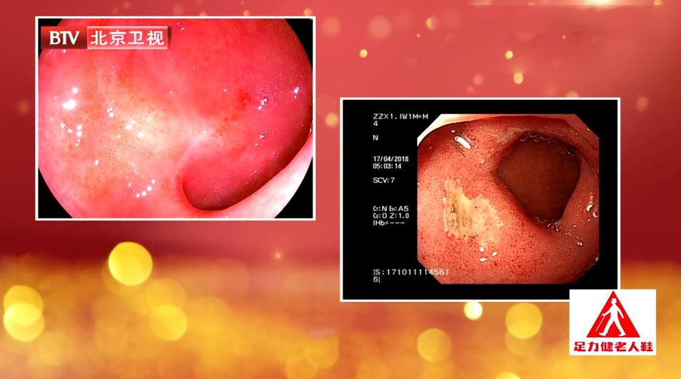 胃病脾胃不好怎么办,脾胃虚寒有胃溃疡怎么治疗