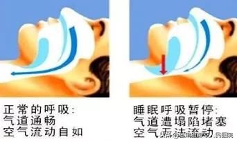 睡眠呼吸暂停综合征科普小知识,呼吸睡眠暂停综合征属于哪个科
