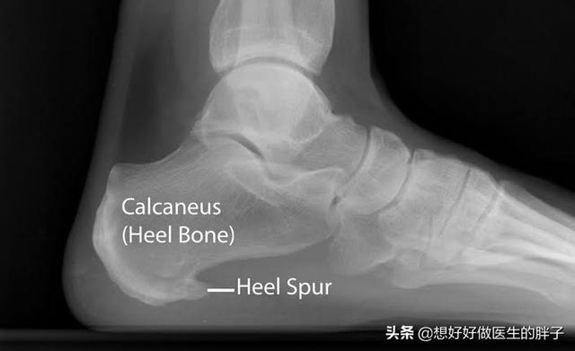 足底骨刺疼痛的原因和治疗方法,足底骨刺痛有什么办法治疗