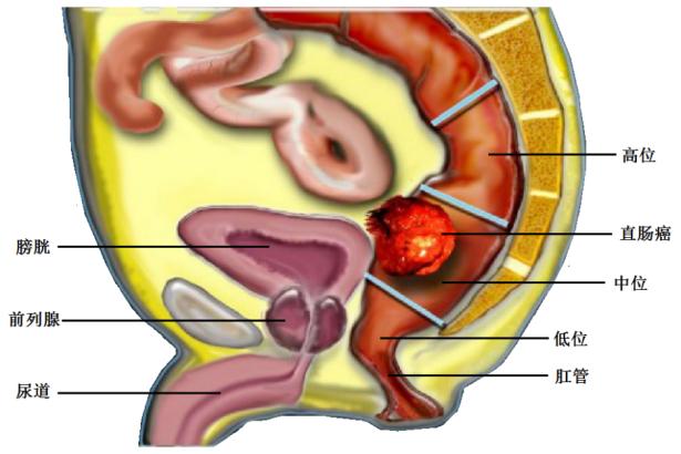 直肠癌保肛术后排大便困难怎么办,直肠癌保肛术后排便困难怎么回事