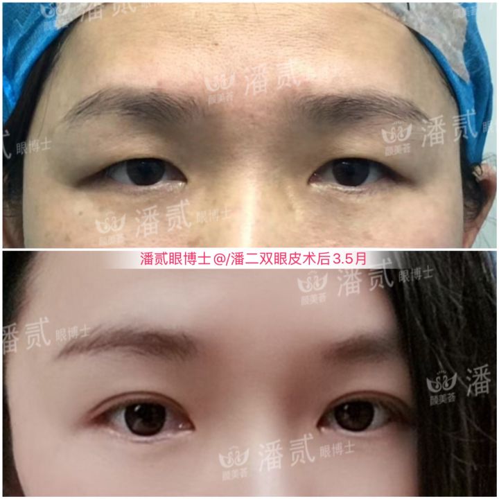 割了开扇双眼皮眼尾上扬太宽,眼尾上扬的眼睛适合什么双眼皮