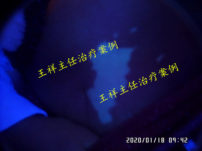 白癜风黑色素种植效果好吗,黑色素种植治疗白癜风费用