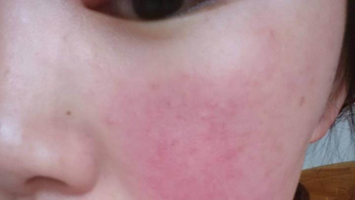 敏感肌肤正在过敏期能用护肤品吗,敏感肌换护肤品有点过敏怎么处理