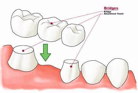 单颗牙缺失搭桥牢固吗,单颗槽牙缺失修复选用哪种方法好