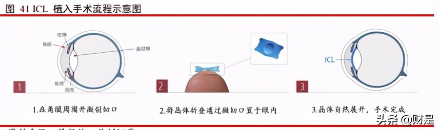 爱博医疗眼科器械上市,眼科行业研究报告