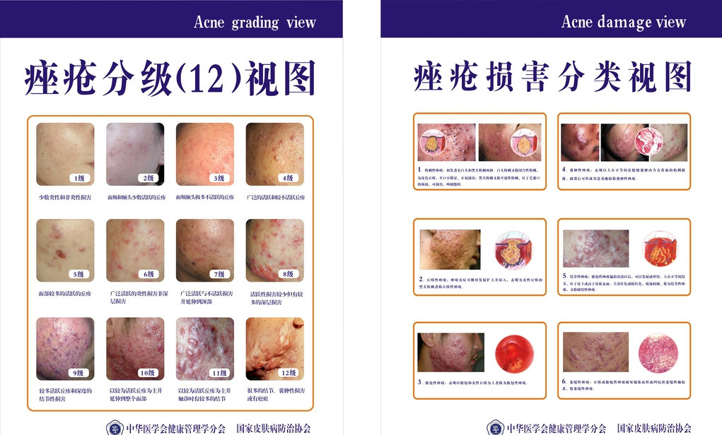 我的战痘历程简介,战痘路上的心酸史