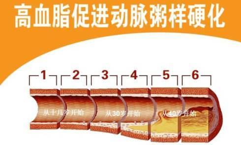 血脂异常到什么程度要吃药,血脂异常吃药下不去