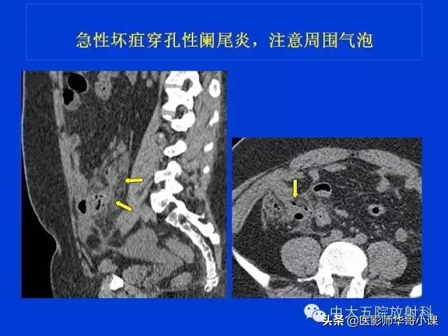 阑尾炎课件,阑尾炎的超声课件