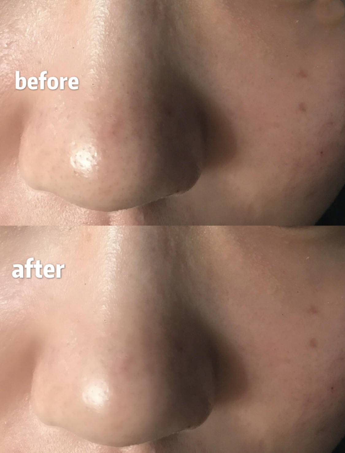 脸上有个光滑不痛不痒的小疙瘩,脸上皮肤粗糙长疙瘩是怎么回事