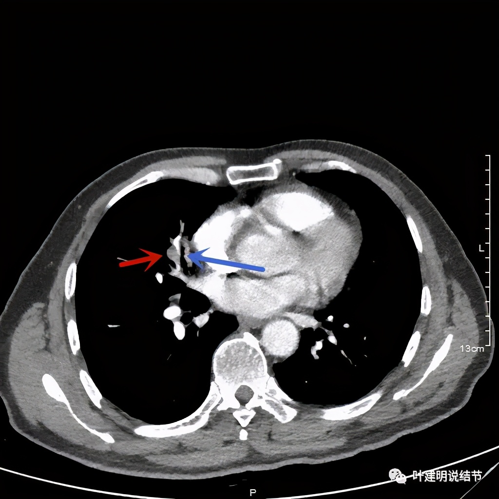 实性结节影要不要紧,实性结节穿刺活检为良性