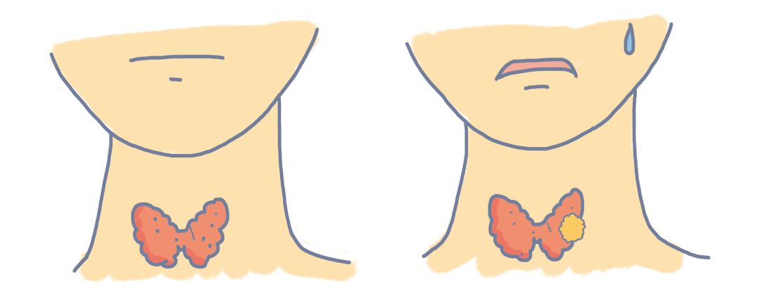 体检时发现结节增生囊肿怎么回事,查出息肉结节怎么办