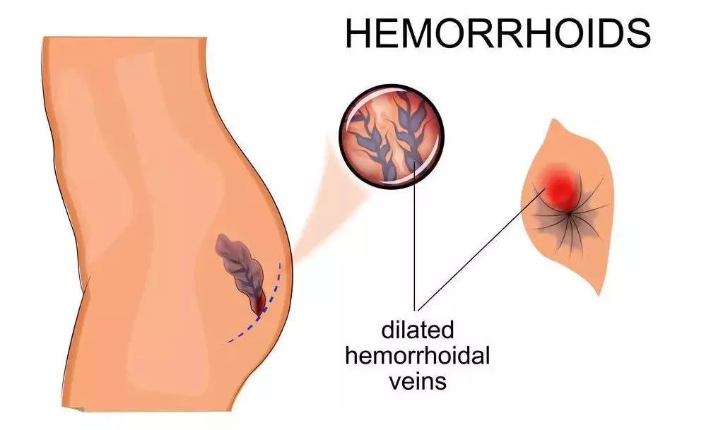 孕妇使用痔疮膏导致流产,怀孕时用麝香痔疮膏会流产吗