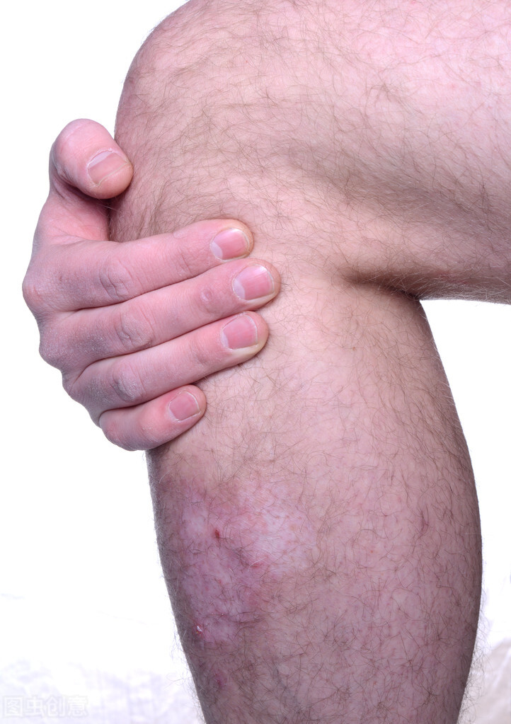 腿上的白癜风用啥药膏好,腿上长白癜风怎么根治