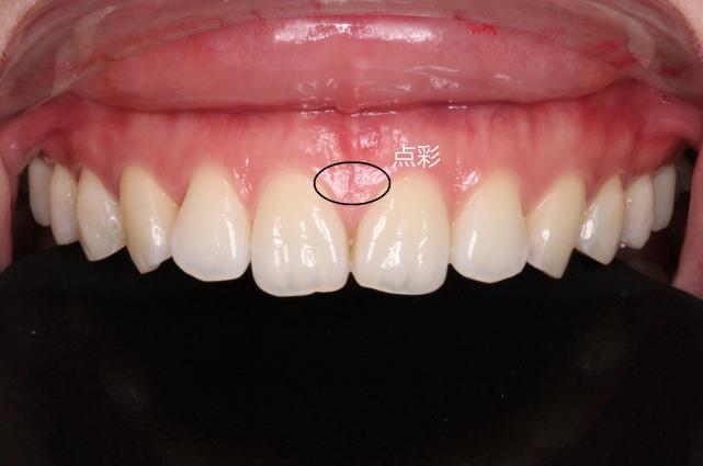 你的牙龈健康吗，5个方面自我检查