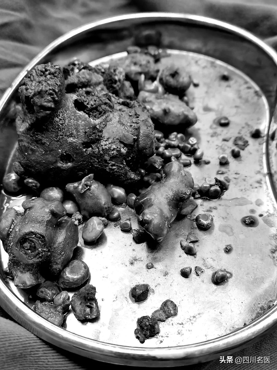 四川53岁男子右肾长了近100颗结石，最大竟有鸡蛋那么大…