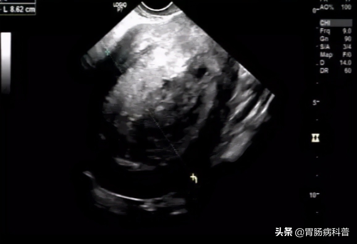 70岁老太太患上了癌症,老年人双下肢长出黑毛毛