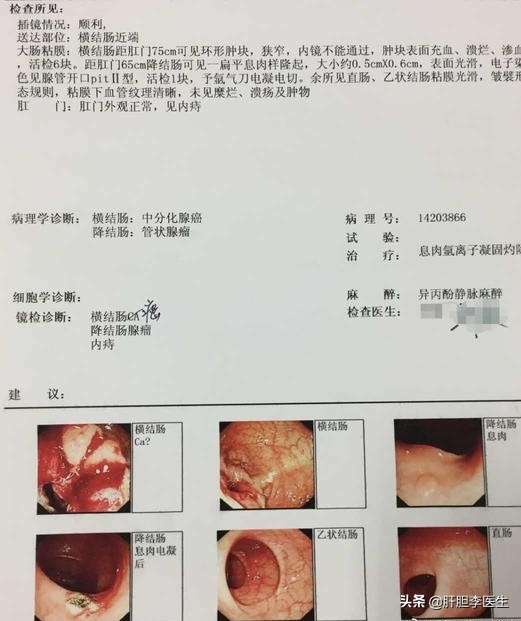 结肠癌晚期怎么才能彻底治愈,结肠癌晚期转移肝可以治愈吗