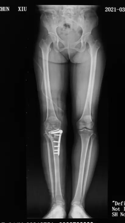 「病例精选」不用换关节，TCVO手术给您新“膝”望