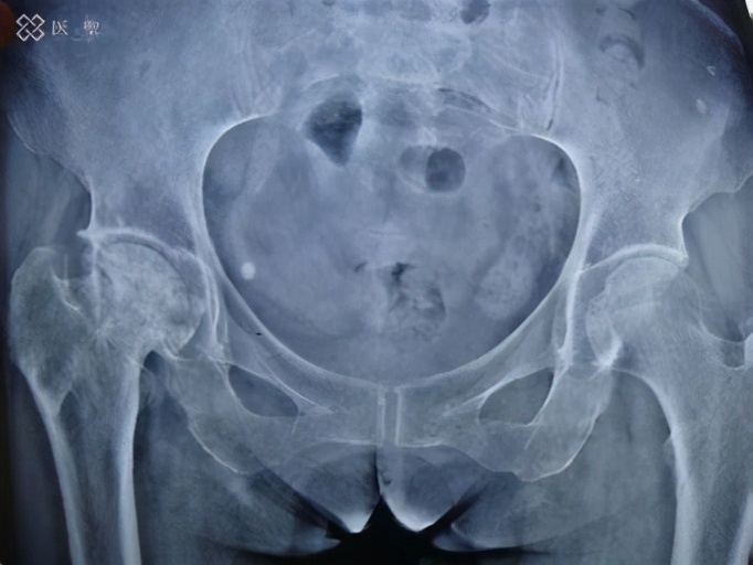 干细胞回输能治疗股骨头坏死吗,造血干细胞治疗股骨头坏死