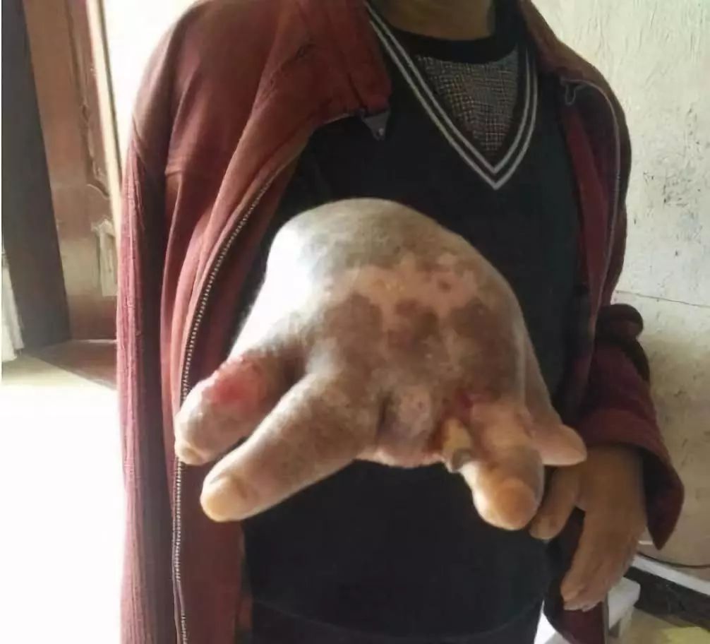 毒蛇咬伤截肢,毒蛇咬食指怎么处理