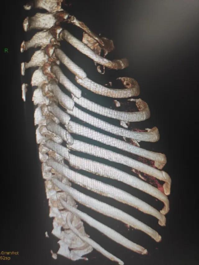 肋骨骨折手术愈后发生哪些后遗症,肋骨骨折切开内固定术是几级手术