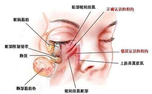如何消除泪沟最有效的方法,泪沟怎么快速消除
