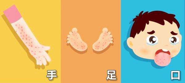 手足口反复烧38左右需要住院吗,宝宝得了手足口必须要住院吗