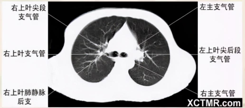 女性盆腔ct断层解剖结构图,女性盆腔脏器ct解剖