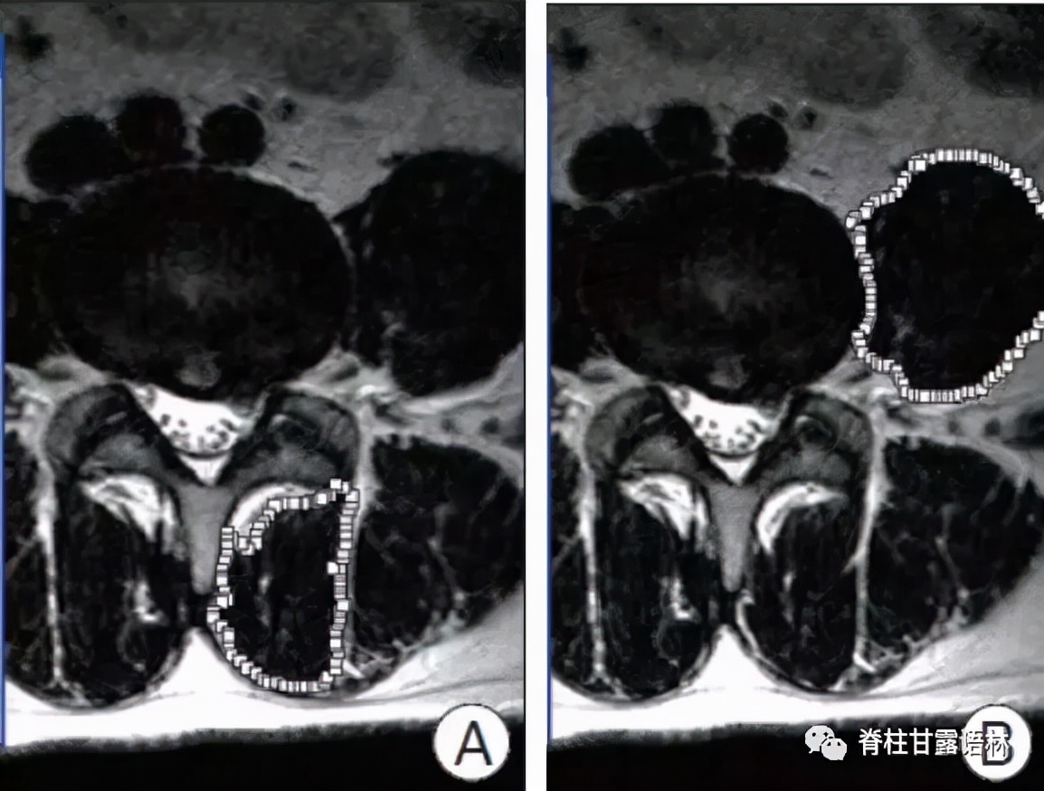 腰椎间盘突出中央型和旁侧型,腰椎间盘与椎板间隙的对应关系