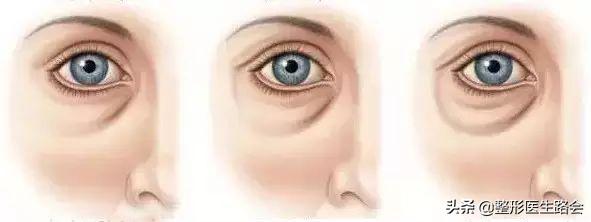 如何区分结构性泪沟,泪沟太明显怎么自己改善
