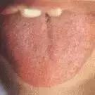 老中医舌苔从厚变薄了,任博士老中医讲舌苔