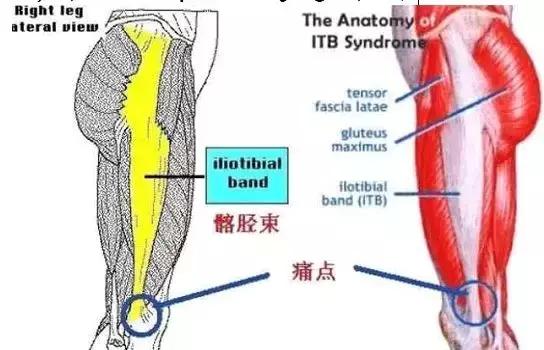 跑者综合症,膝盖外侧痛髂胫束综合征